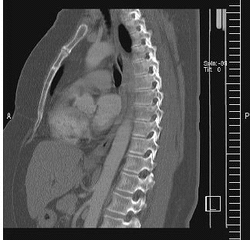 Thorax-CT #2  - CT, Computertomographie, Thorax, Brustkorb, Aufnahme, Röntgen, Rippen, Wirbelsäule, Wirbel, Wirbelkörper, Bandscheibe, Organe, innere Organe, Radiologie, Brustbein