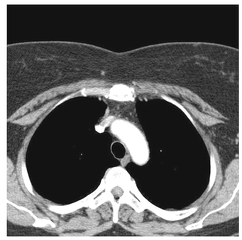 Thorax-CT #3 radial - CT, Computertomographie, Thorax, Brustkorb, Brustbein, Aufnahme, Röntgen, Lungen, Rippen, Wirbelsäule, Wirbel, Radiologie, Querschnitt, Luftröhre, Brustgewebe