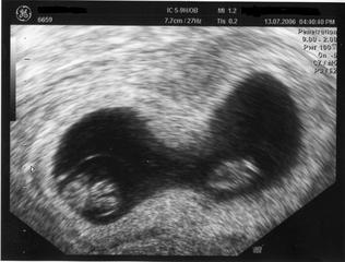 Ultraschall 1 - Ultraschall, Zwillinge, Schwangerschaft, zweiter Monat, Uterus