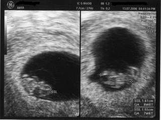 Ultraschall 2 - Ultraschall, Zwillinge, Schwangerschaft, zweiter Monat, Uterus